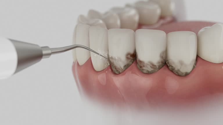 Reliable Dental Implants contractor in Marathon, FL by Smile Center Dentistry